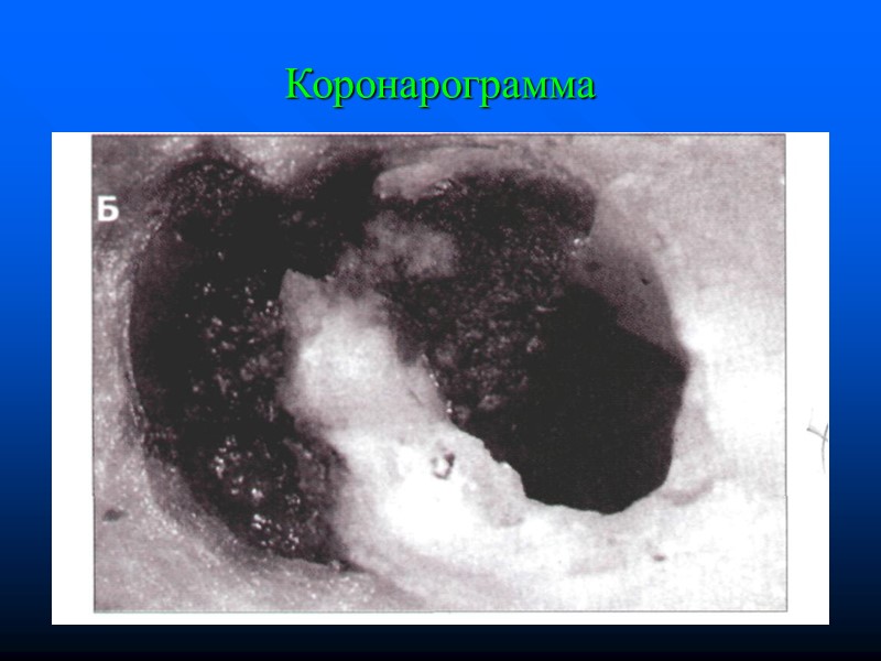 Коронарограмма Коронарограмма